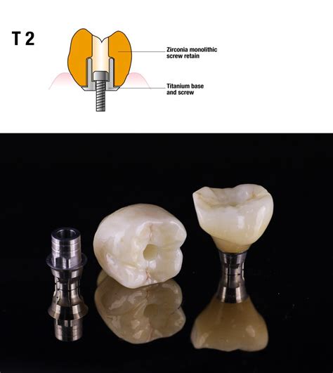 Screw Retained Implant On Titanium Base Inta Dental Studio