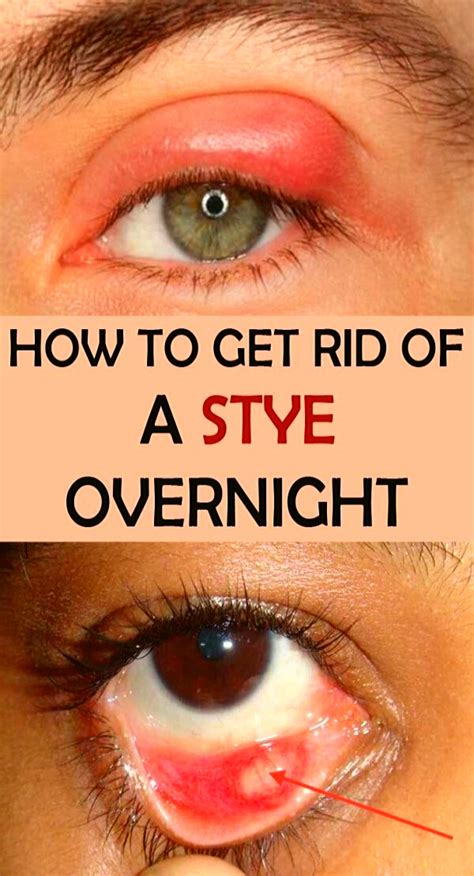 How To Get Rid Of A Stye Overnight Health Health Remedies Eye Stye Remedies