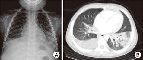 A Chest X Ray Showed Patchy Consolidation In The Right Middle Lobe