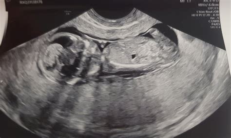 12 Week Scan Retroverted Uterus Babycentre