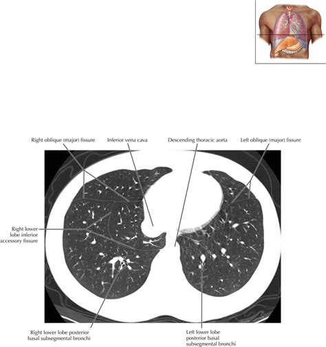 Pulmonary Anatomy And Variants Radiology Key