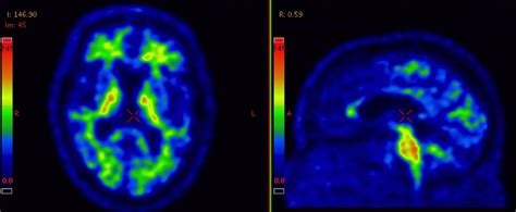 Amyloid Pet Imaging The Swedish Biofinder Study