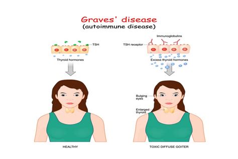 Graves Disease What It Is Causes Symptoms And Treatment Betahealthy