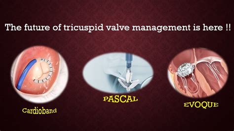 Transcatheter Therapies Future Of Tricuspid Regurgitation Management