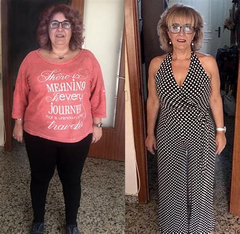 Weight Loss Surgery Before And After Photos Nordesthetics Clinic