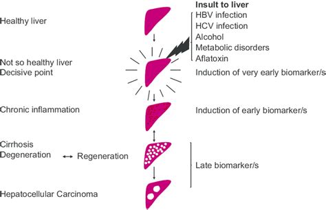 Stages Of Hepatocellular Carcinoma Development And Induction Of