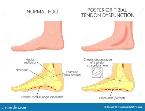 Medial Ankle Injuryposterior Tibial Tendon Dysfunction Stock Vector