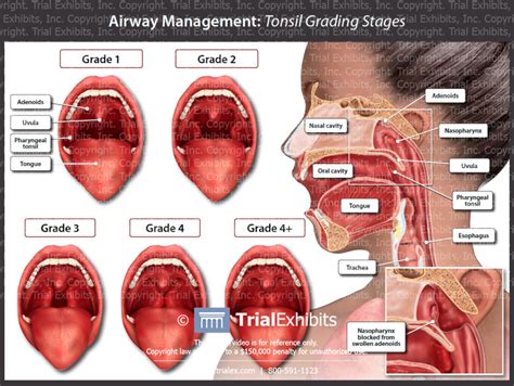 Airway Management Tonsil Grading Stages Trial Exhibits Inc
