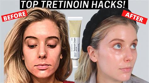 Top Tretinoin Tips How To Use Tretinoin Without Irritation Tretinoin