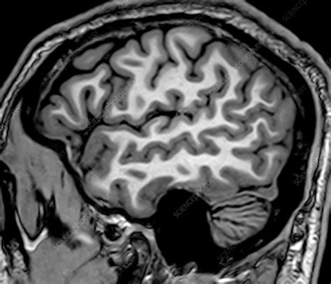 Normal Sagittal T1 Mri Brain 1 Stock Image C0393731 Science