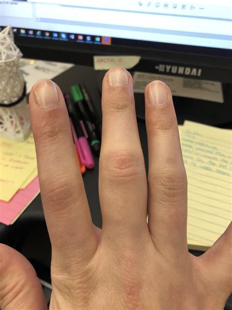 Recent finger swelling, middle joint, no obvious cause. I’ve had very