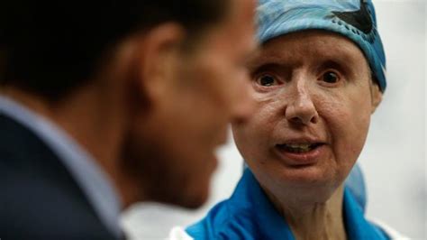 Body Of Chimp Attack Victim Rejecting Face Transplant