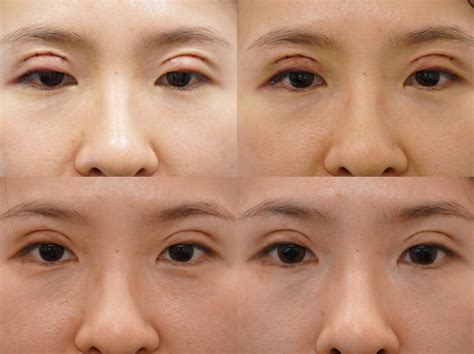 Review Double Eyelid Surgery Done In Singapore With Love