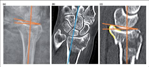 Figure 1 From Comparison Of Extra Articular Radiographic Parameters Of