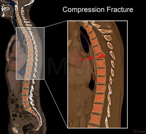 Color Ct Scan Thoracic Spine Anatomy Compression Fracture Anatomy