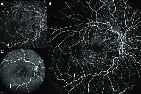 Swept Source Optical Coherence Tomography Angiography SS OCTA And