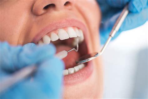 Curetaje Dental En Qué Consiste El Tratamiento Y Qué Beneficios Tiene