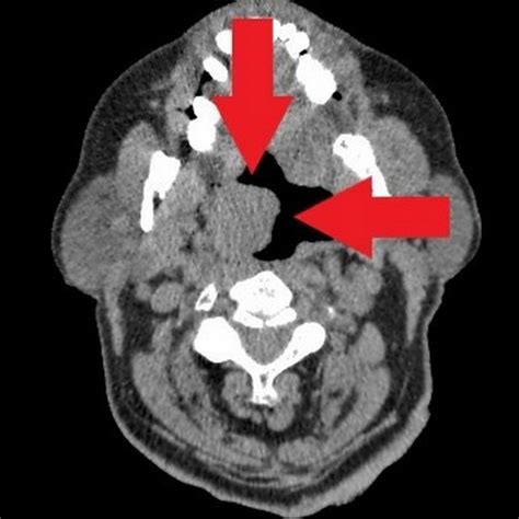 Pdf Lymphoepithelial Carcinoma Of The Palatine Tonsil