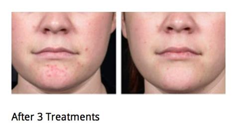 Isolaz Laser Therapy Before After Uses A Combination Of Light And Vacuum To Minimize Acne