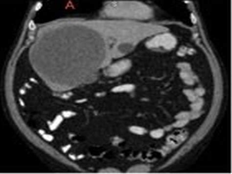 Haemorrhagic Rupture Of Hepatic Simple Cysts Bmj Case Reports