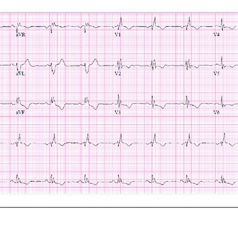 Ecg Showing Right Axis Deviation With Right Atrial And Ventricular Hot Sex Picture