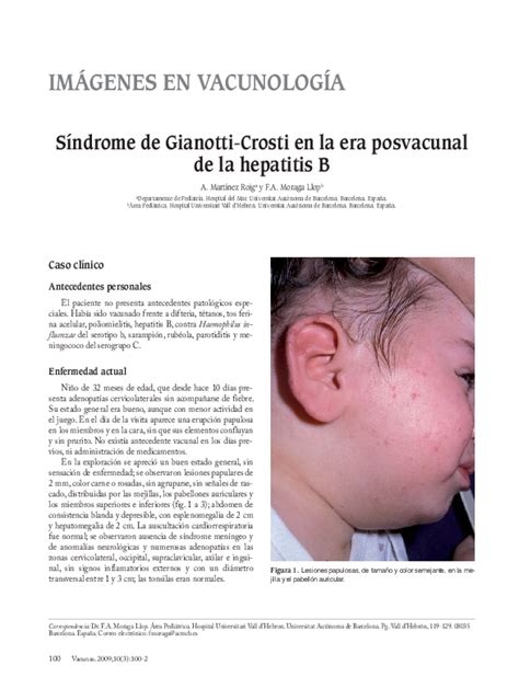 Pdf Síndrome De Gianotti Crosti En La Era Posvacunal De La Hepatitis