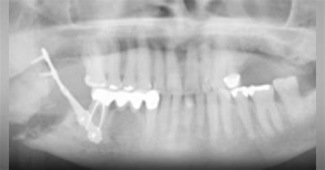 Update Osteonecrosis Of The Jaw Onj Dentistry Iq