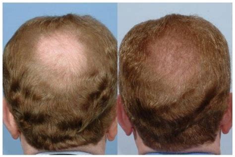 Top Image What Causes Hair Loss Thptnganamst Edu Vn
