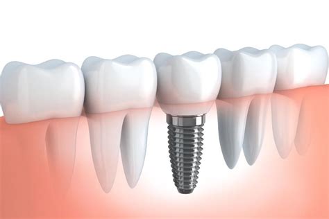 Dental Implants Your Questions Answered Bowie Dentist