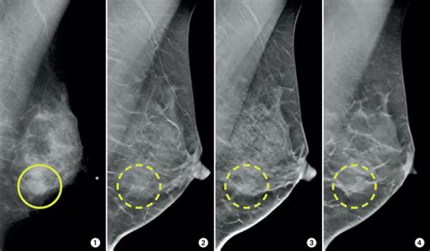 D Mammograms May Improve Accuracy Of Breast Cancer Screening