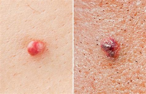 Skin Cancer Examples