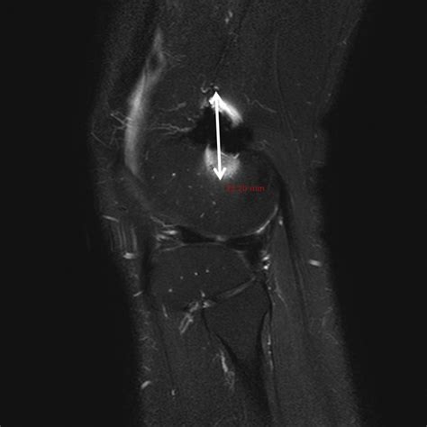 Reduced Metallic Artefacts In 3 T Knee Mri Using Fast Spin Echo Multi