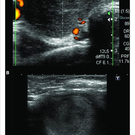 Different Sonographic Pattern Observed In Patient With Hla B1801