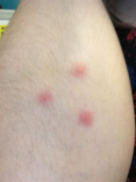 Itchy Bumps On Skin Like Mosquito Bites Pictures PeepsBurgh Com