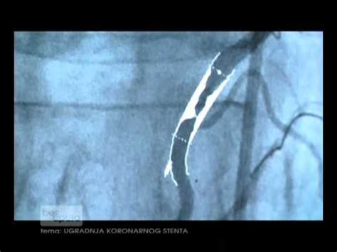 Koronarna Angioplastika In Vstavitev Stenta Zdravilo