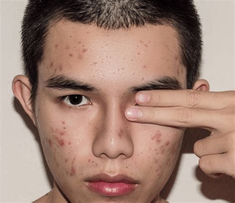 Kenalan Dengan Hiserha Gentle Acne Facial Wash Sabun Cuci Muka Untuk Pria Yang Berjerawat