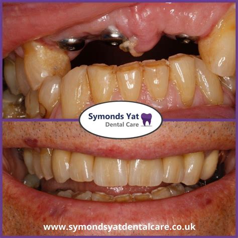 Dental Implants Near You Herefordshire Symonds Yat Dental Care