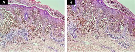 Bullous Lesion Borders Containing Tumor Cells And Loss Of Intercellular