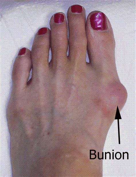 Bunions Bunion Treatment Bunion Surgery Bunion Pain