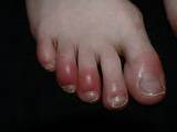 Big Toenail Infection Home Remedies Pictures