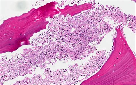 Pathology Outlines Bacterial Osteomyelitis Acute