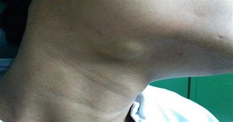 Right Submandibular Swelling Which Increases With Food Intake