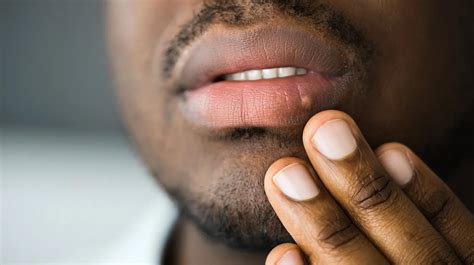 Oral Stds Symptoms Treatment And More