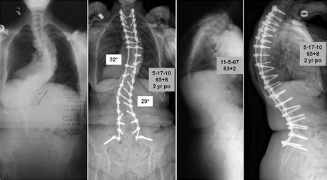 Adult In Scoliosis Adulte Archive