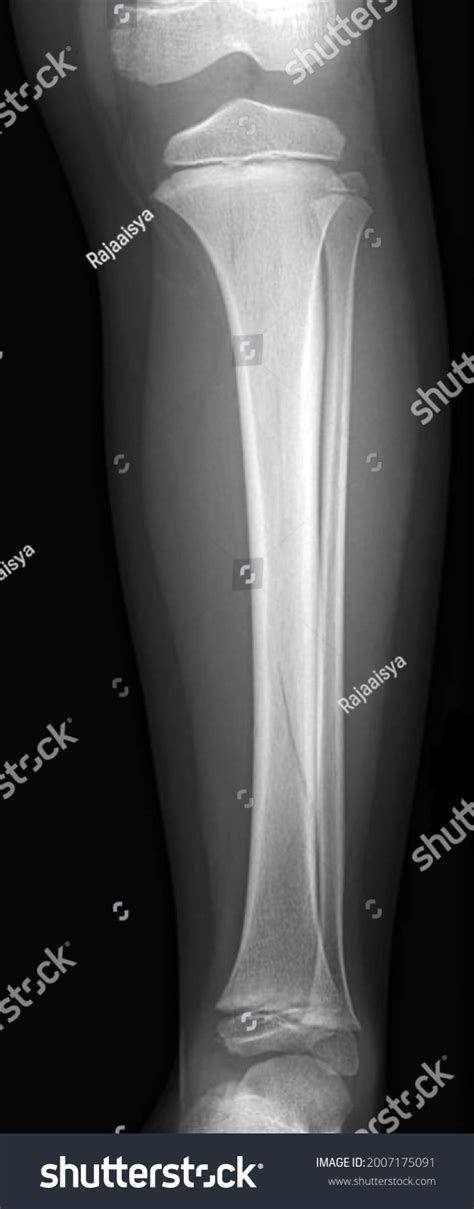 Spiral Fracture Tibia Bone Xray Foto Stock 2007175091 Shutterstock