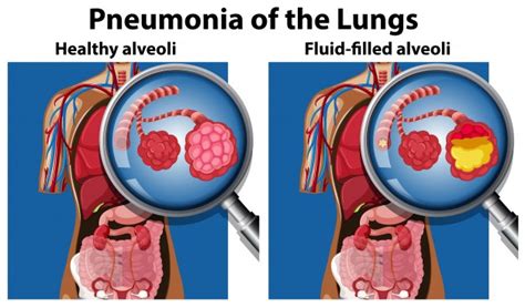 Human Lung With Pneumonia Vector Premium Download