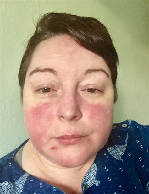 Lupus Can Cause A Red Butterfly Shaped Rash Across The Nose And Cheeks