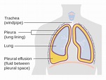 胸腔積液 - 維基百科，自由的百科全書