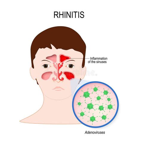 Sinusitis Stock Vector Illustration Of Runny Nose Rhinitis 35869358