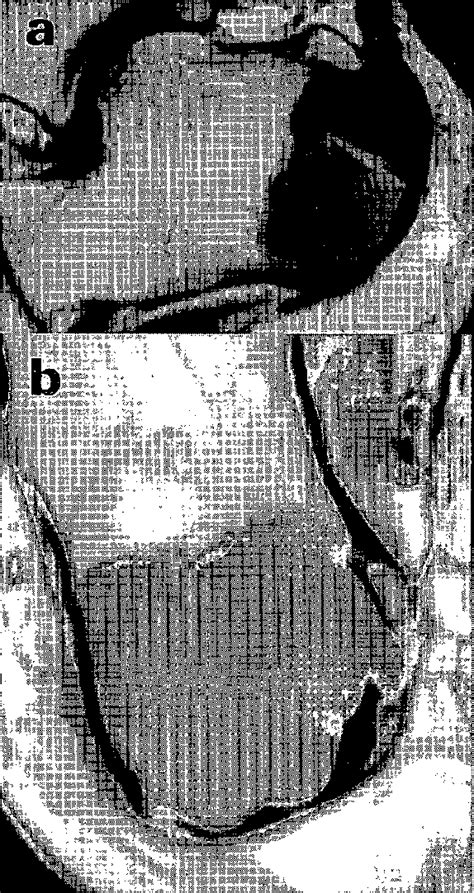 Figure From Aneurysmal Bone Cyst Arising From A Giant Cell Tumor Of